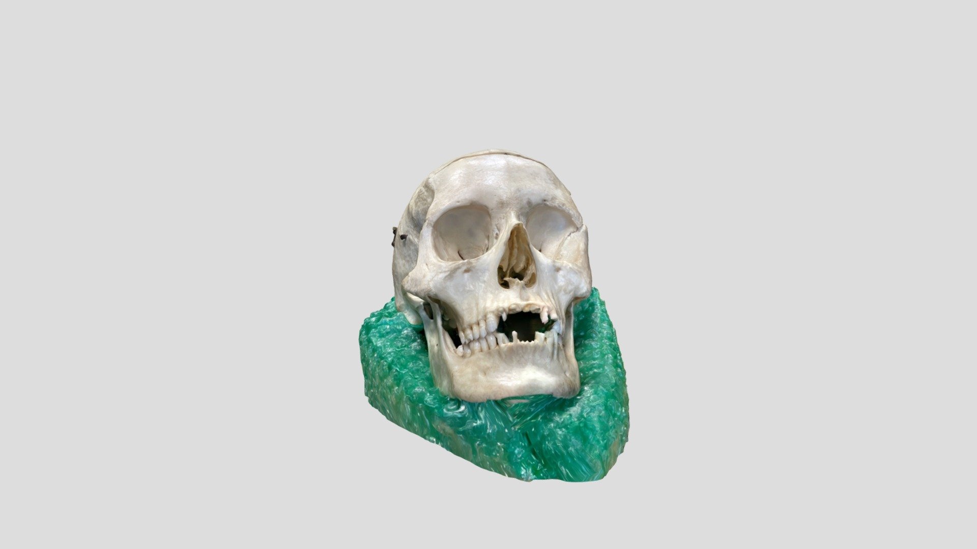 Fully Modern Human with Fracture