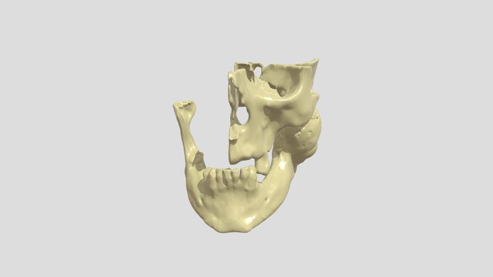 Maxilla, mandibula, tumor 3D Model