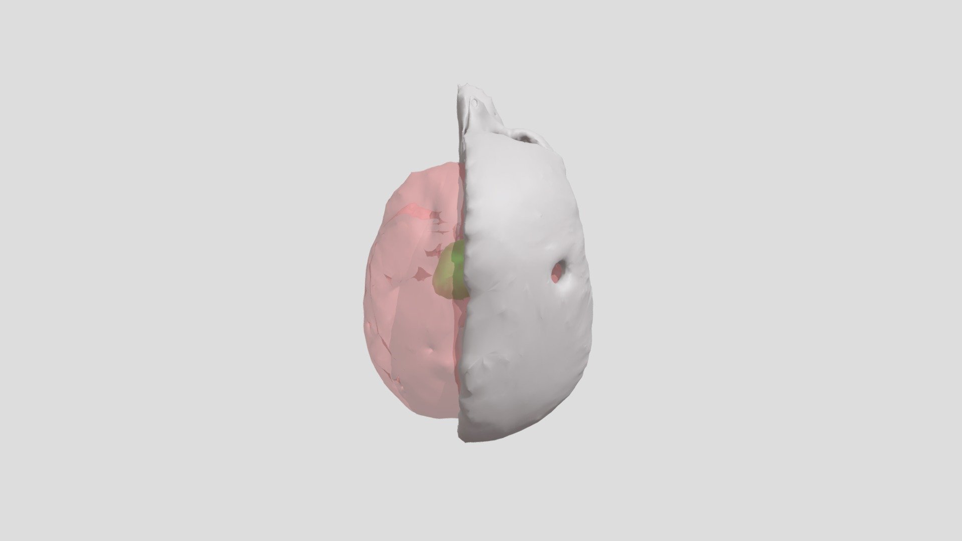 1D: 3D Model of a CT Brain with Tumor, Cronin