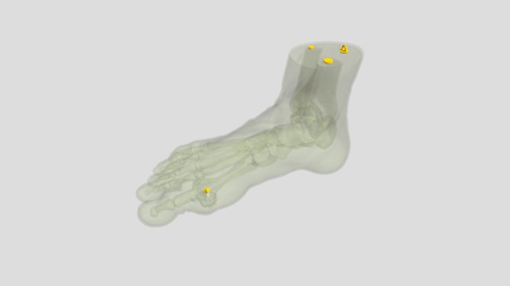 Gout Foot Model 3D Model