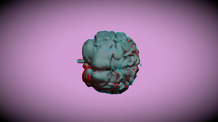 Progression of Alzheimer's 3D Model