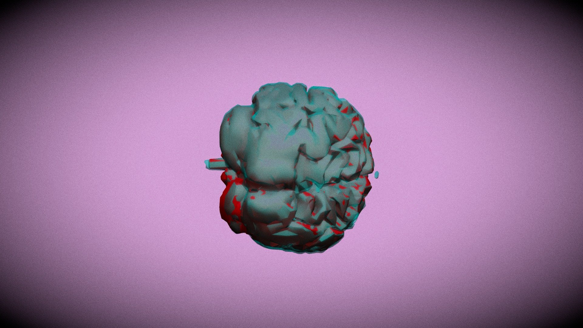 Progression of Alzheimer's
