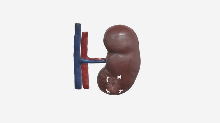 Kidney Cancer - Small Renal Mass (Repaired) 3D Model