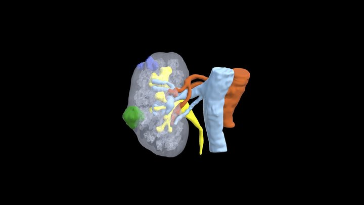 Right Renal Tumor (F.A.M.) 3D Model