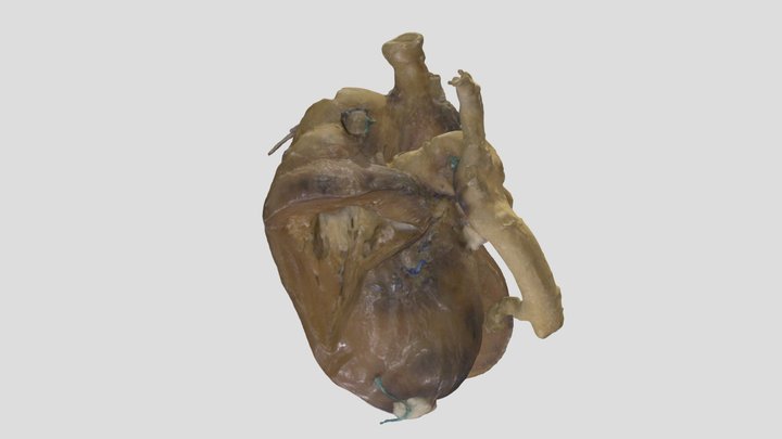 Transposition of Great Arteries_A7955 3D Model