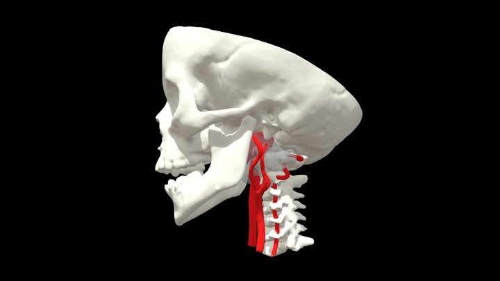 ICA Pseudoaneurysm 3D Model