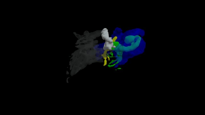 CSF Leak 3D Model