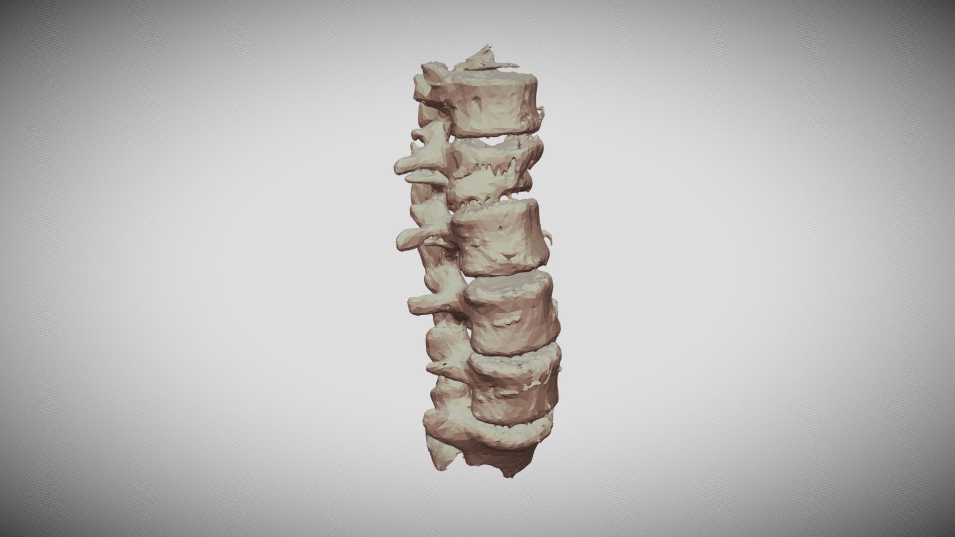 AOspine_Thoracolumbar_TypeC_L1 - 3D model by E_Schulz [4026a1a] - Sketchfab