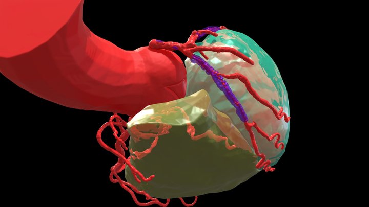 Stent_PCCT 3D Model