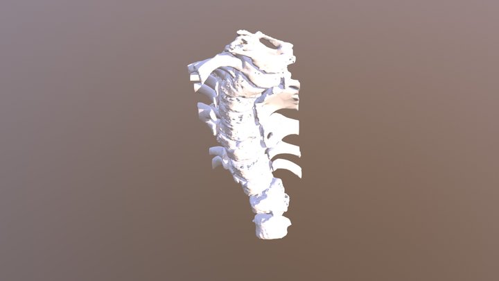 Congenital Scoliosis 3D Model