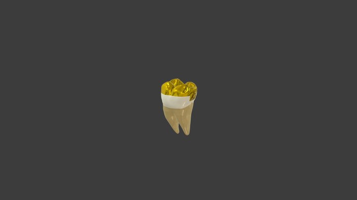 Gold Onlay 3D Model