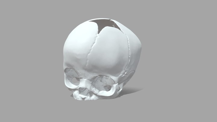 Craniosynostosis Skull Model 3D Model