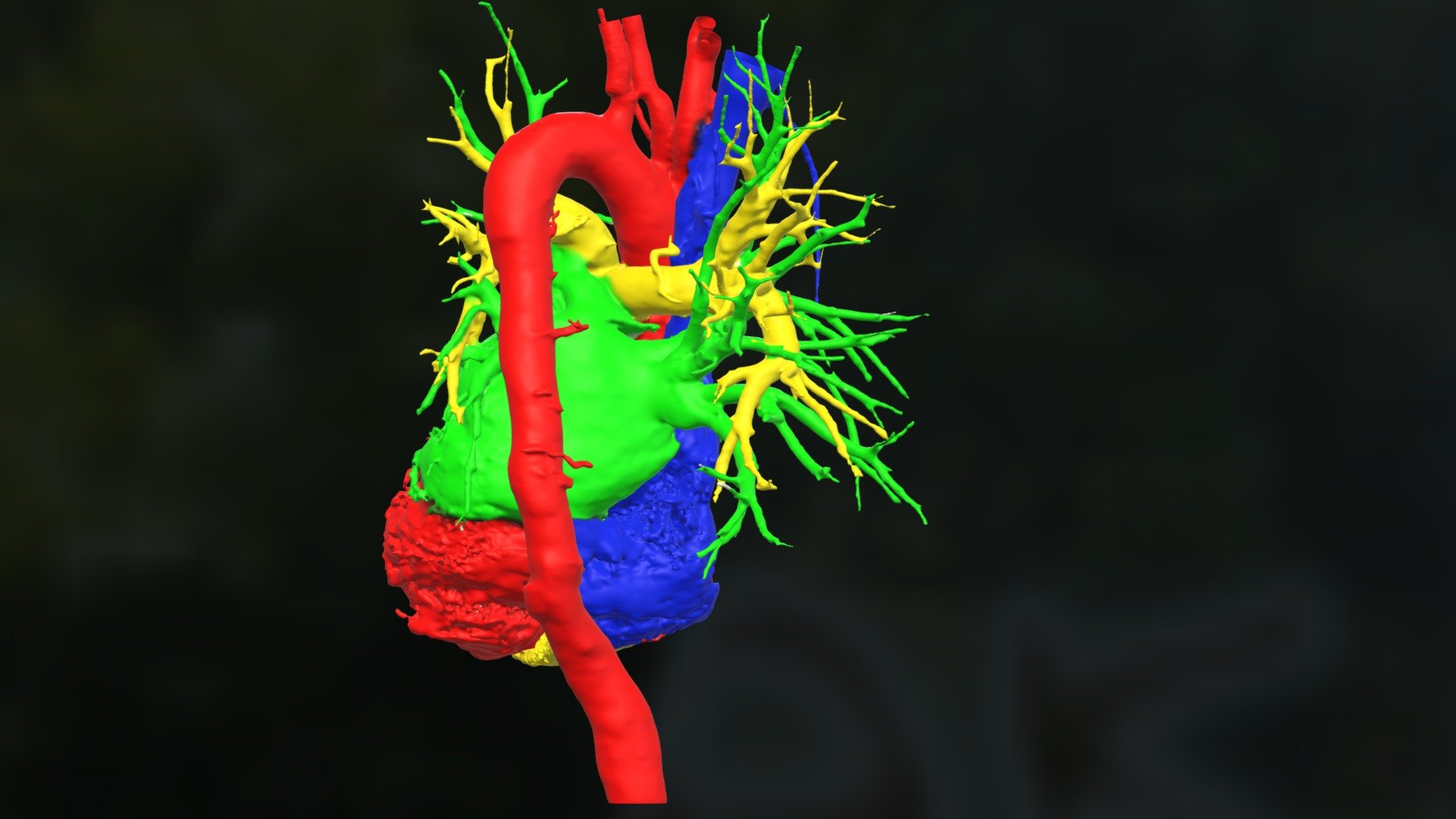 Aneurisma Da Aorta Toracica 3d