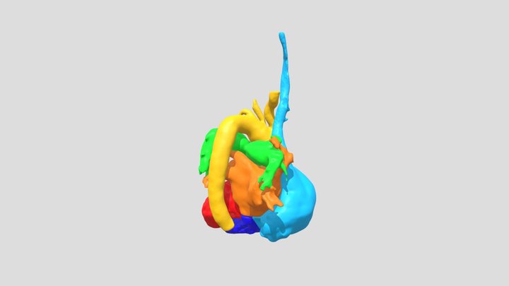 Tetralogy of Fallot 3D Model