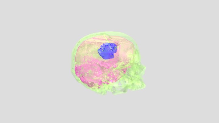 Brain, Tumor, Skulls, Oh My! 3D Model