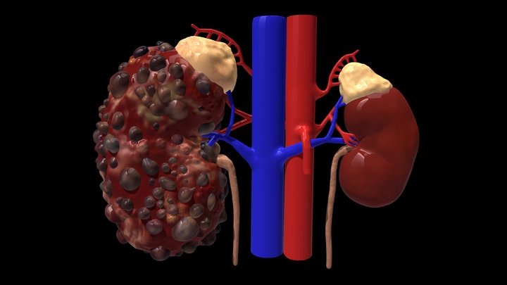 Polycystic kidney disease 3D Model