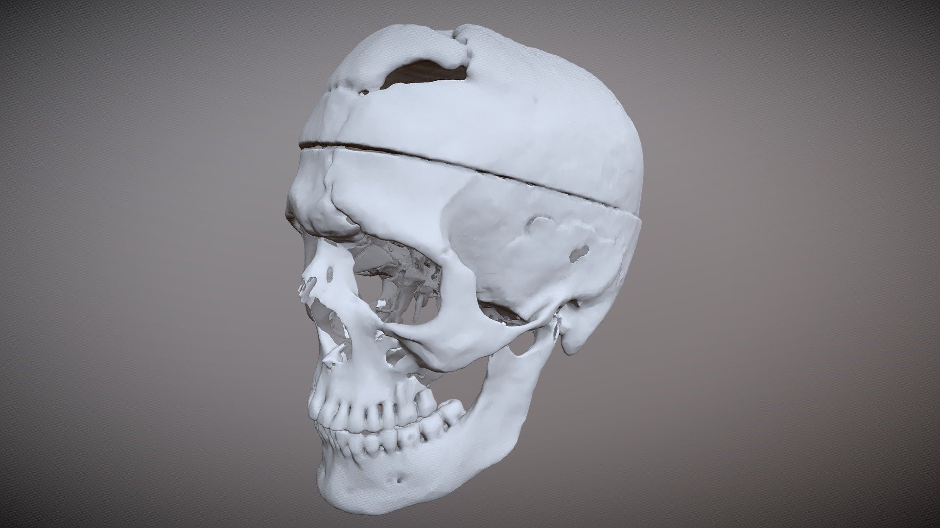 Skull of Phineas Gage