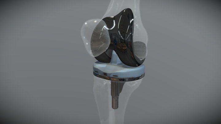 Total Knee Replacement Device 3D Model