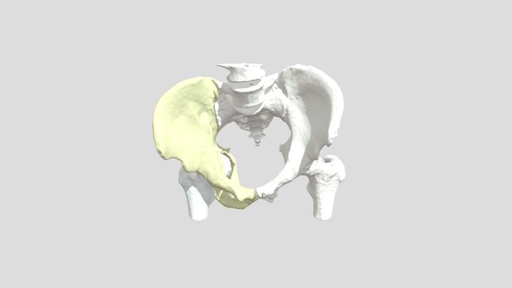 Paciente Freire - 3D Hip   Dr Felipe Serrano 3D Model