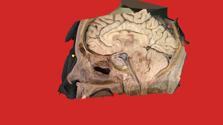 Sagitall head: NasalSideWall &Mega-antrostomy 3D Model