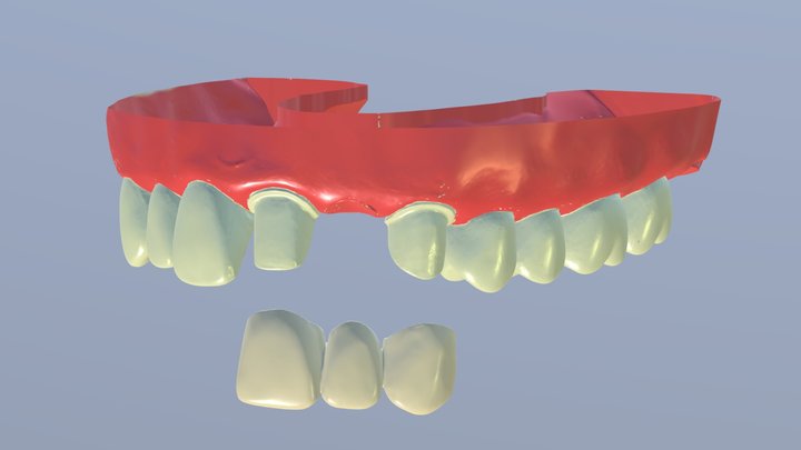 Provisional FPD on Teeth #9 to 11 3D Model
