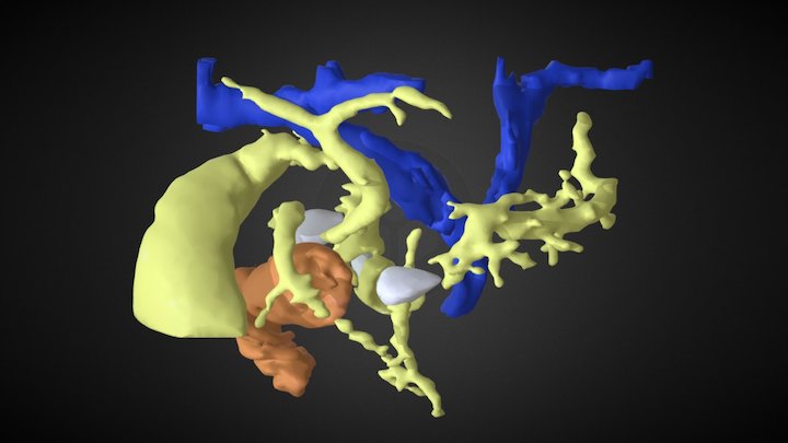 Annular Pancreas With Portal Vein 3D Model