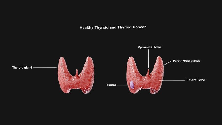 Healthy Thyroid and Thyroid Cancer 3D Model