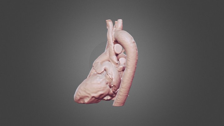 A rare anatomical variant of vena cava 3D Model