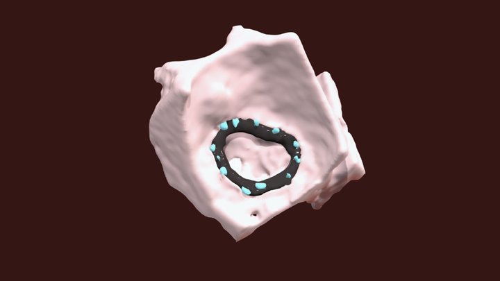 Mitral Valvoplasty posterior rupture 3D Model