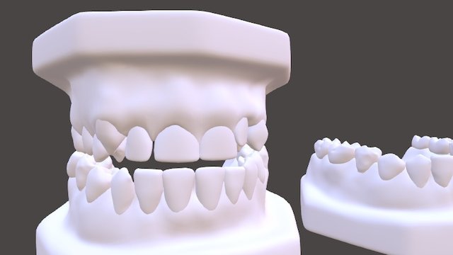 ClassIII-Posterior Crossbite 3D Model