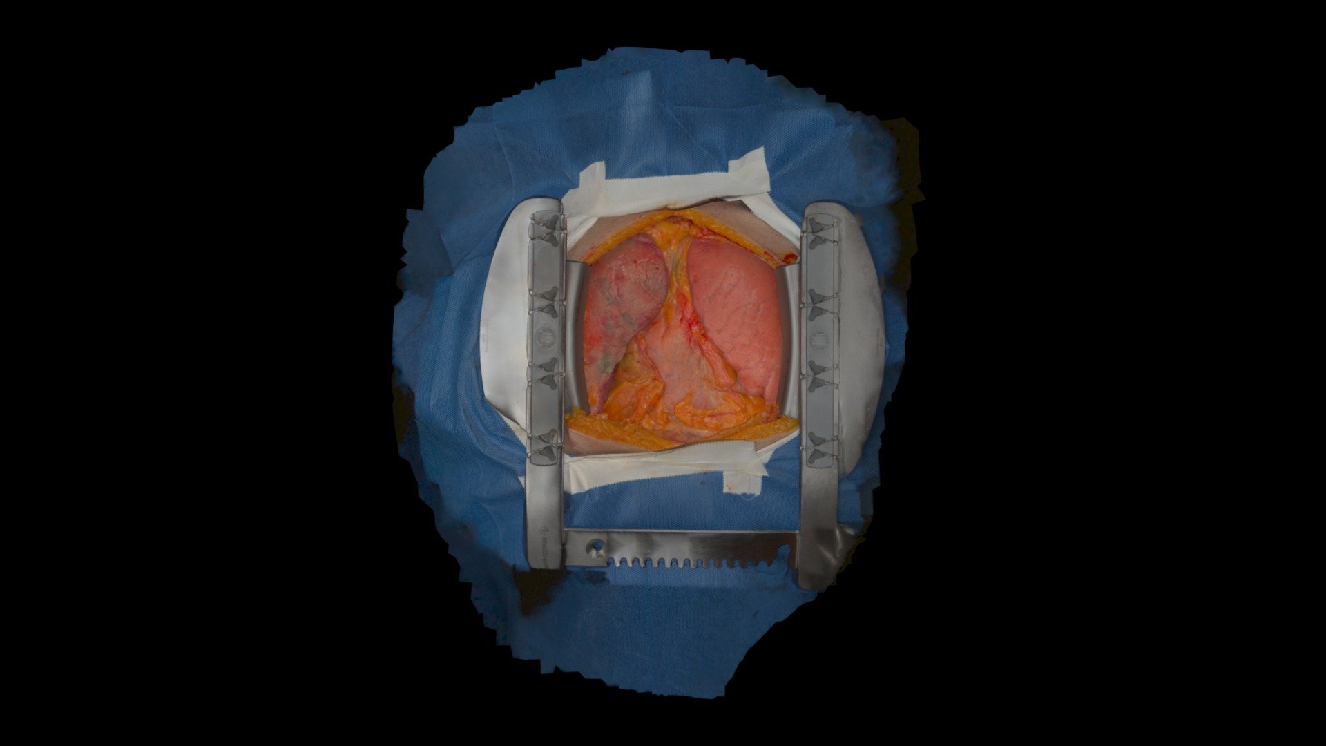 Cadaver Dissection Step 2 Lungs Inflated 3D model by