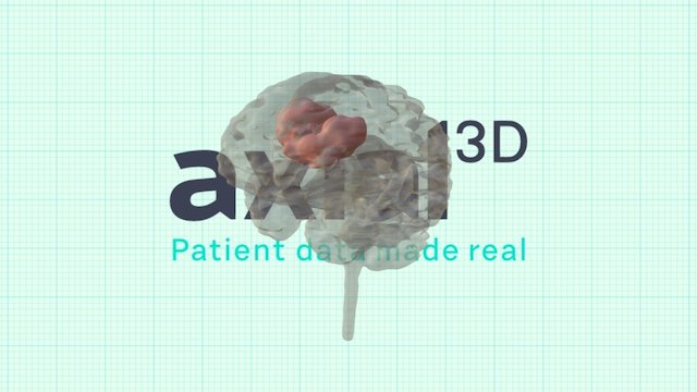 Brain and tumour 3D Model
