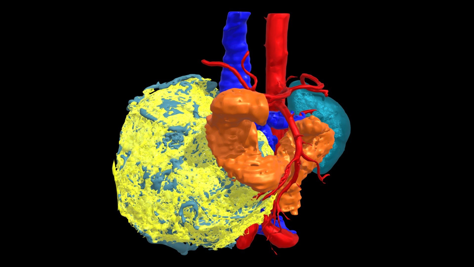 renal-mass-3d-model-by-tecdes-sa-tecdessa-45a41cf-sketchfab