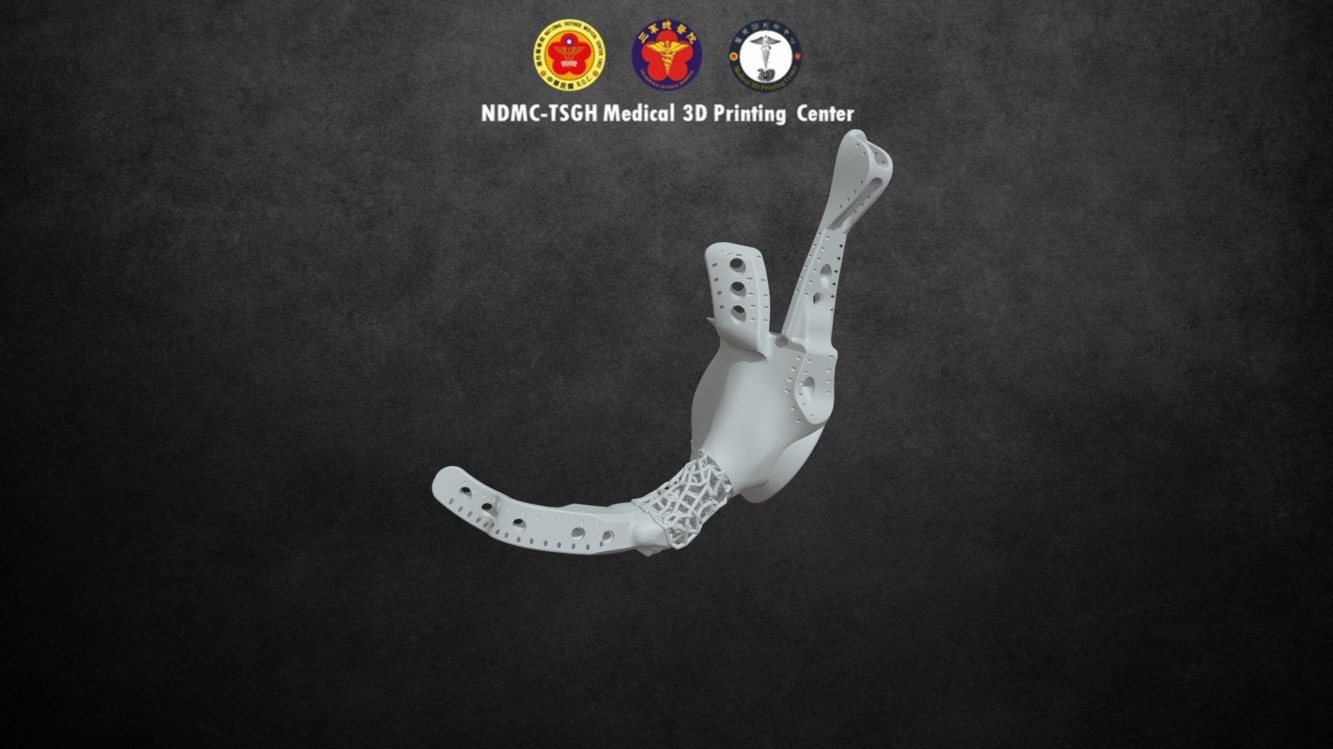 Pelvis Implant Final