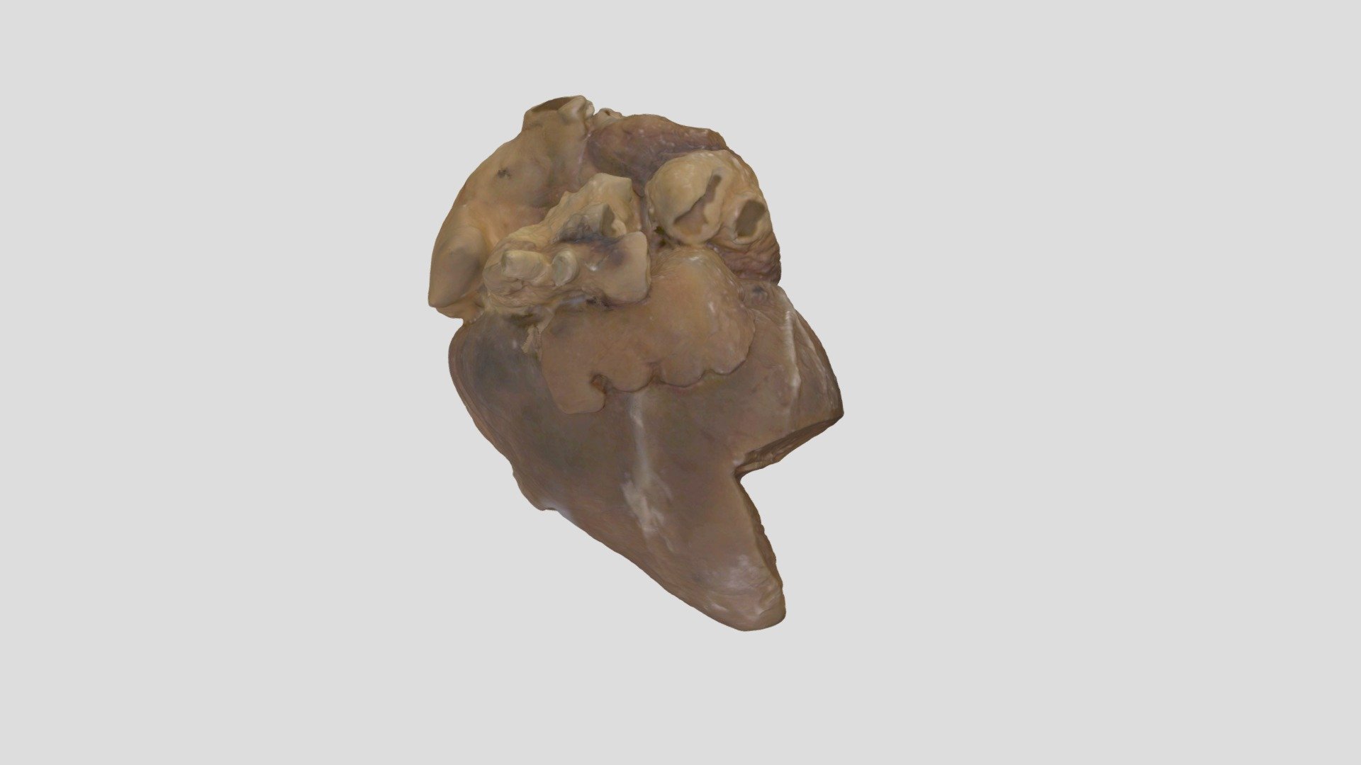 Truncus Arteriosus_A8162