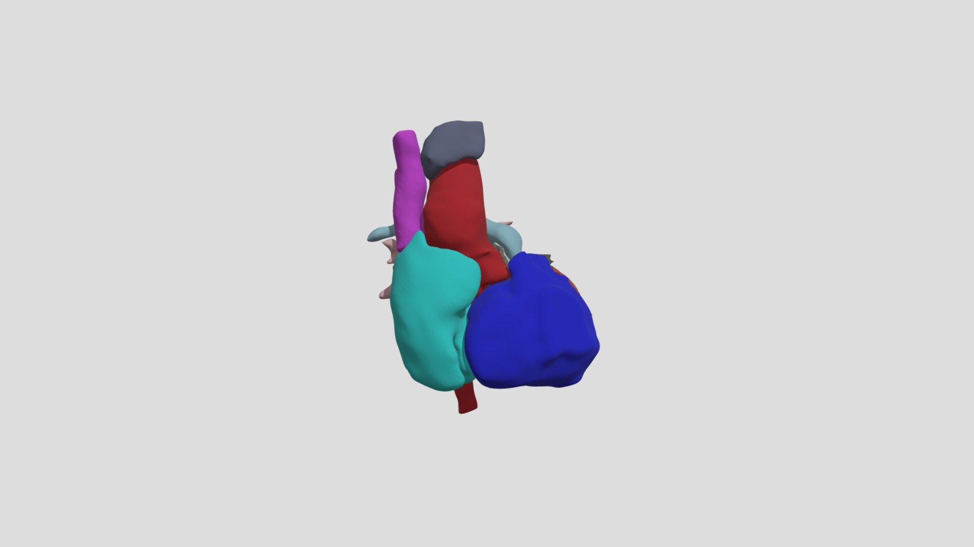 Tetralogy of Fallot