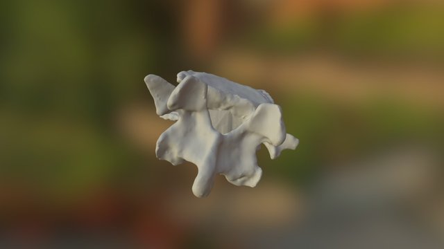 UWF5 Lumbar Vertebra Osteoarthritis 3D Model