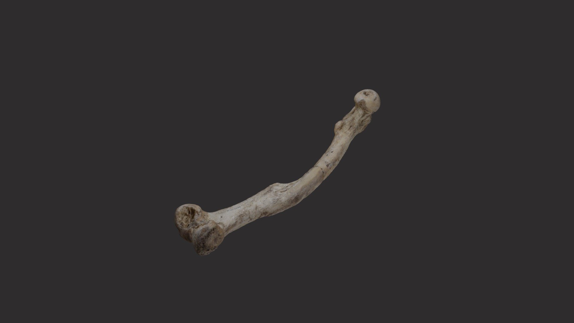 Human Femur (Paget's Disease)