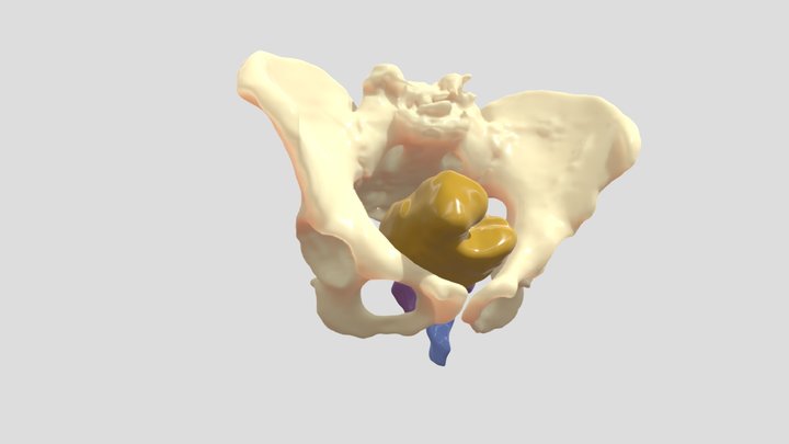Cáncer de recto - CGD_IPM_211023_1 3D Model