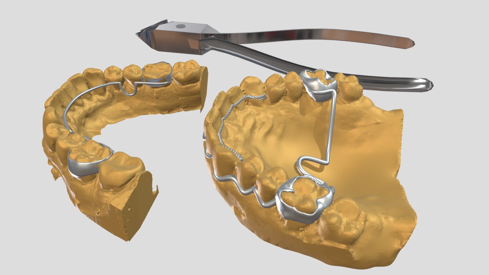 Ortho Fixed Appliances - 3D model by justericho1 [474231d] - Sketchfab