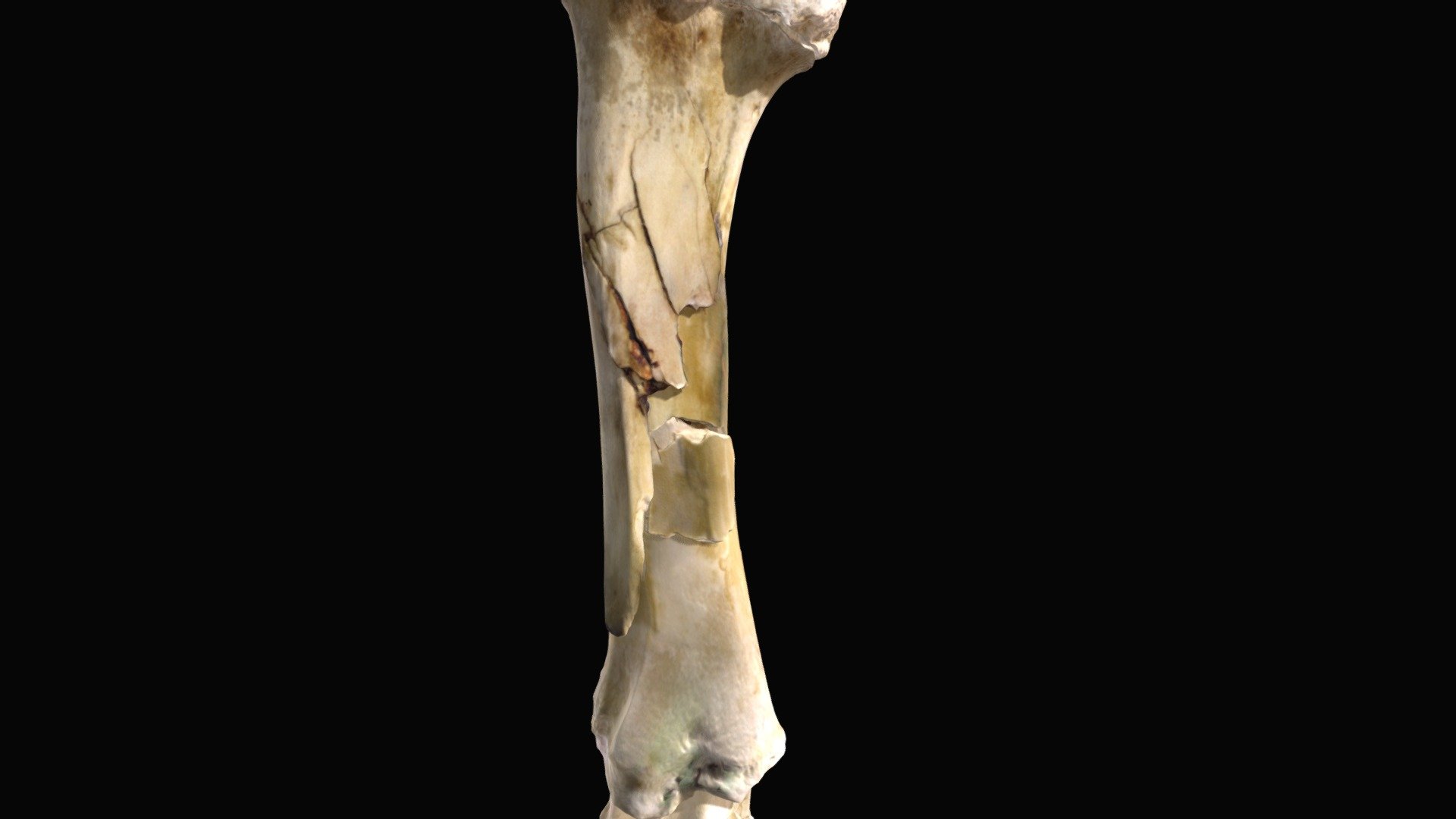 Broken right tibia - 3D model by lkbryan41 [476ee7f] - Sketchfab