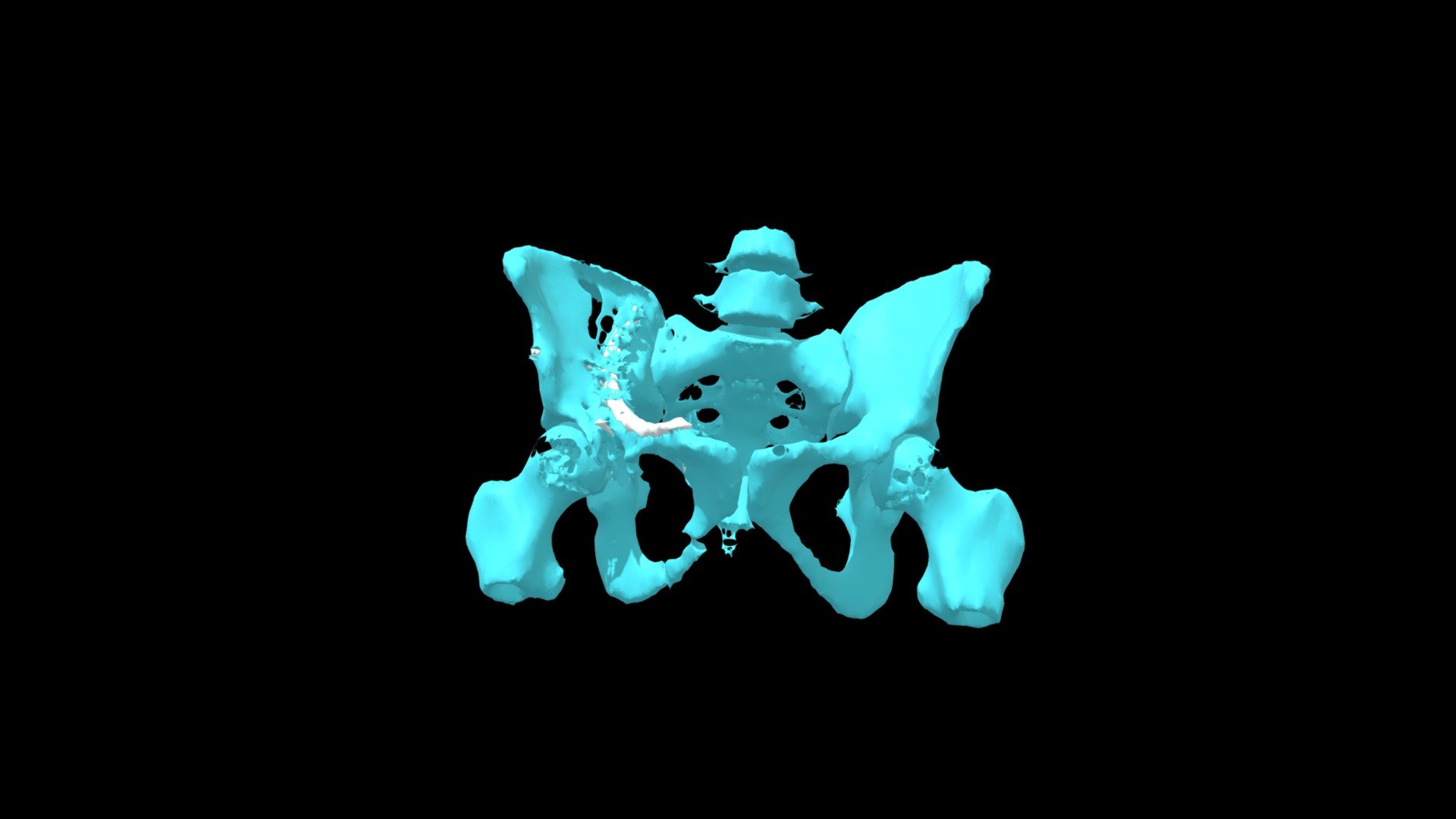 Fractured Pelvis