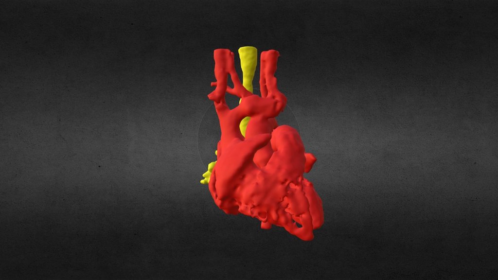 Tracheal stenosis, middle third