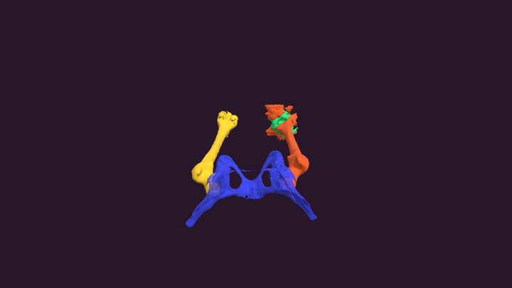 Femur Segmentation 3D Model