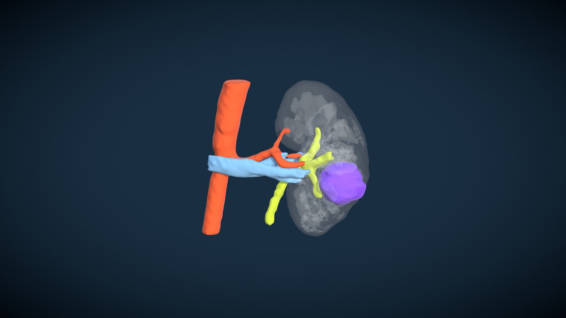 Left Renal Tumor (C.C.R.)