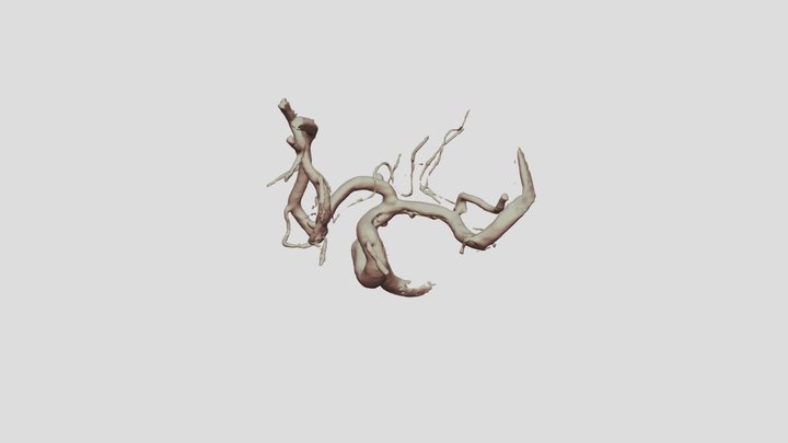 Left A1 aneurysm 左侧大脑前动脉动脉瘤 3D Model