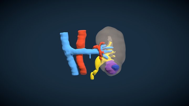 Left Renal Tumor (F.A.R.) 3D Model