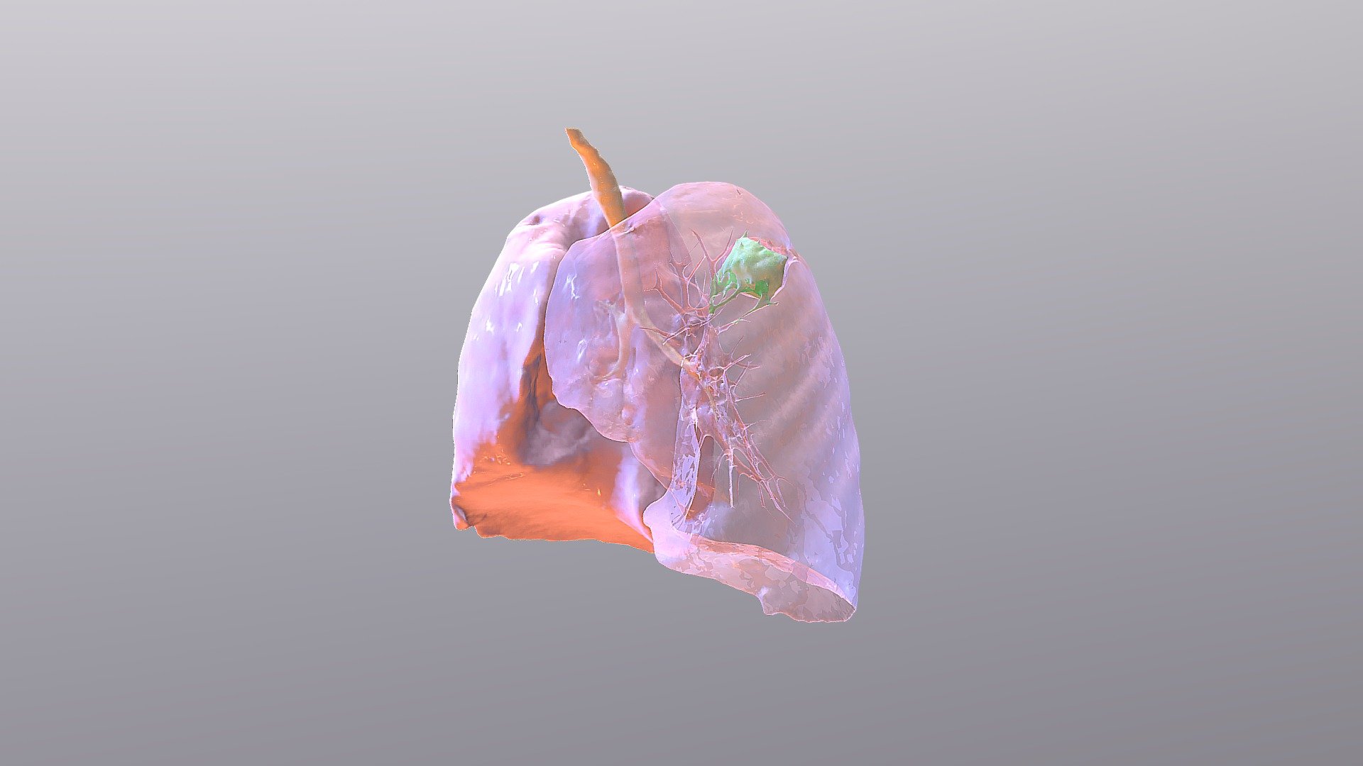 Lung Carcinoma - Download Free 3D model by Brandon Holt (@BrandonHolt ...