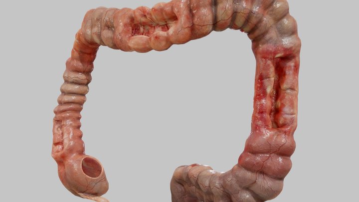 Crohn's disease 3D Model