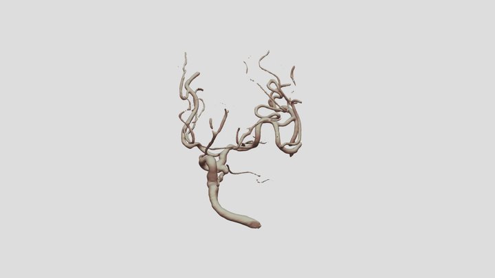 Ruptured P-com Aneurysm 3D Model